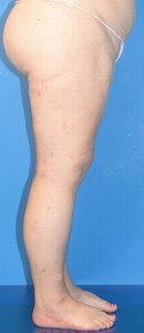 Ordensklinikum Linz Beine einer Patientin mit Lipödem nach der Operation