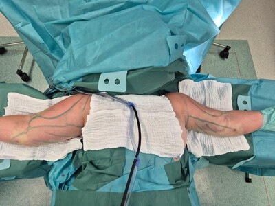 Ordensklinikum Linz Intraoperative Liposuktion an den Oberarmen: Volumen vor und nach der Fettabsaugung