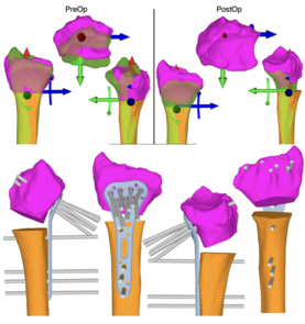 Die CT-Aufnahmen mit 3D Rekonstruktion vor und nach der Operation zeigen das wiederhergestellte Handgelenk